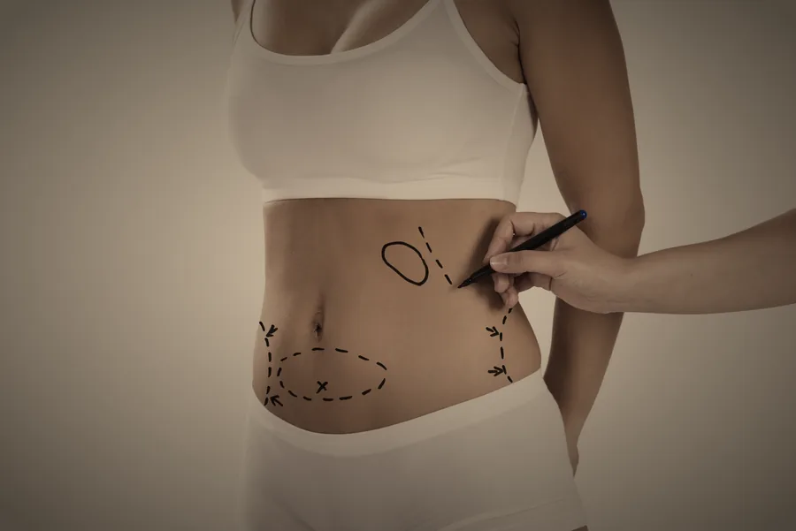 Abdomen femenino con definición atlética y natural tras una lipomarcación en Madrid