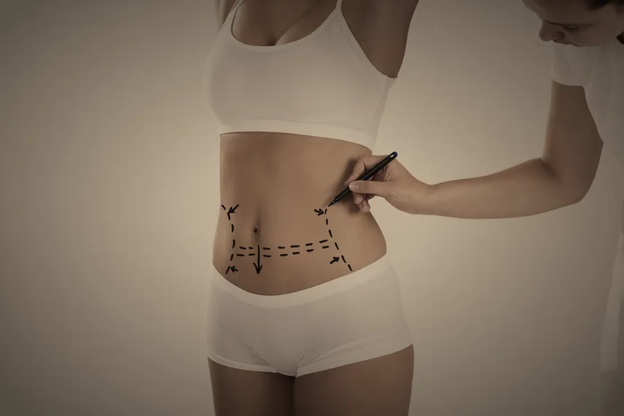 Abdomen plano de mujer tras una abdominoplastia, con la cicatriz baja oculta bajo la ropa interior, Madrid